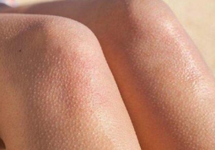 علت دون دون شدن پوست بعد از لیزر