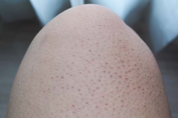 علت دون دون شدن پوست بعد از لیزر