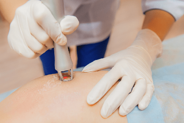 لیزر اگزایمر برای درمان ترک‌های قرمز روی پوست