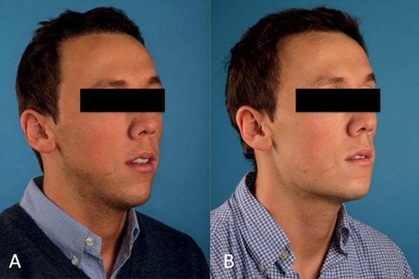 ایجاد زاویه در فک مردان با تزریق بوتاکس