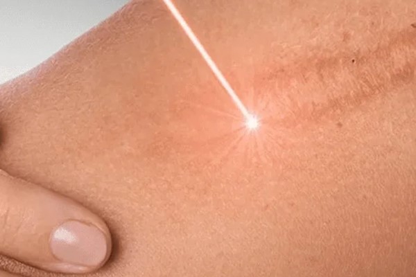 حذف آثار بخیه با اشعه نور لیزر فرکشنال