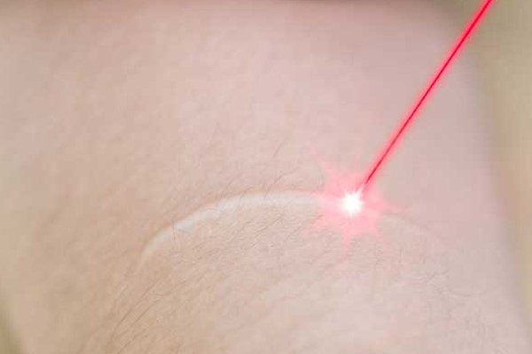 حذف جای بخیه با لیزر اربیوم