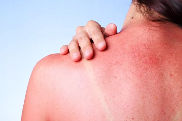 قرار گرفتن در نور خورشید و آفتاب سوختگی پس از لیزر 