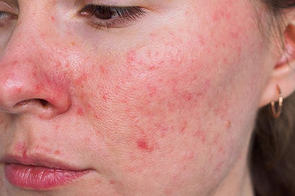 قرمزی و التهاب پوست به‌دلیل استفاده از کرم‌های لایه‌بردار 