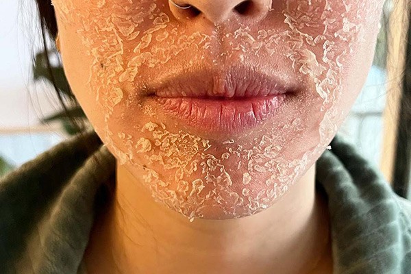 پوسته پوسته شدن صورت بعد از میکرونیدلینگ 