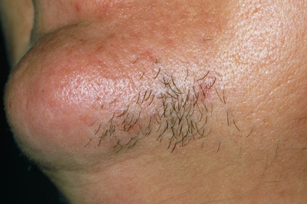 اختلالات هورمونی؛ رشد بیشازحد موی ضخیم بعد از لیزر