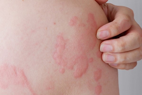 منع انجام لیزر موی زائد درصورت کهیر