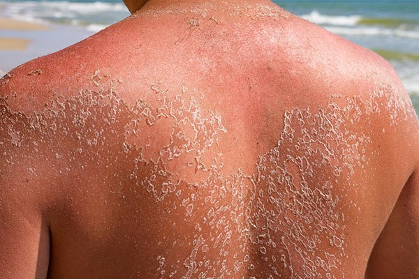 سوختگی پوست درصورت زمان نامناسب برای آفتاب گرفتن