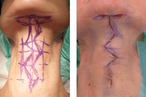 به‌جا ماندن جای بخیه؛ یکی از عوارض‌ عمل لیفت گردن 
