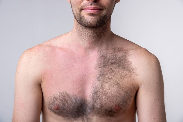 نظم نداشتن در تعداد جلسات لیزر؛ نتیجه منفی در حذف همه موهای زائد