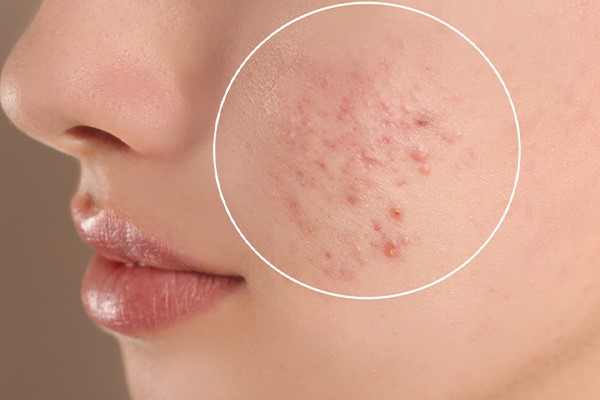 رفع جوش و جای جوش با انجام عمل سابسیژن 