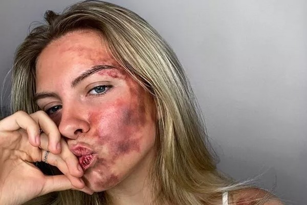 تورم و کبودی؛ عوارض‌های عمل سابسیژن 