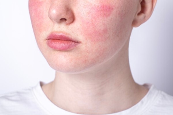 تحریک و قرمزی پوست با فشیال، بلافاصله بعد از تزریق بوتاکس 