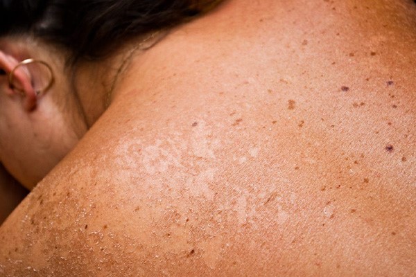 سوختگی و تیره شدن پوست به‌دلیل برنزه کردن پوست بعد از لیزر 