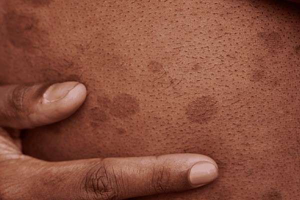 لکه‌های تیره به‌دلیل استفاده از اسپری قبل از لیزر 