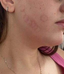 سوختگی بعد از هایفو