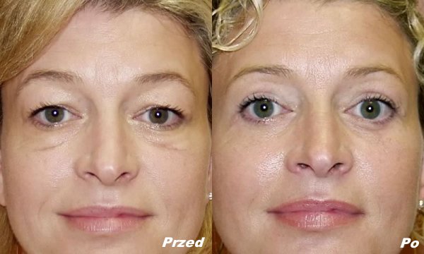 کاربردهای هایفوتراپی دور چشم